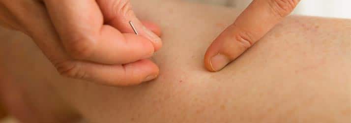 Chiropractic Columbia MO Acupuncture Article