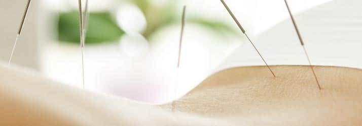 Chiropractic Columbia MO Acupuncture for Back Pain Article