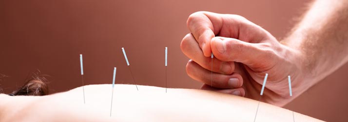 Chiropractic Columbia MO Prepare for Acupuncture Article